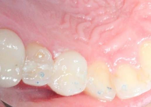 Fractured Tooth before treatment Fractured Tooth before treatment