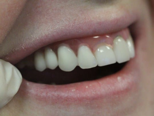 Replace Missing Teeth before treatment Replace Missing Teeth before treatment