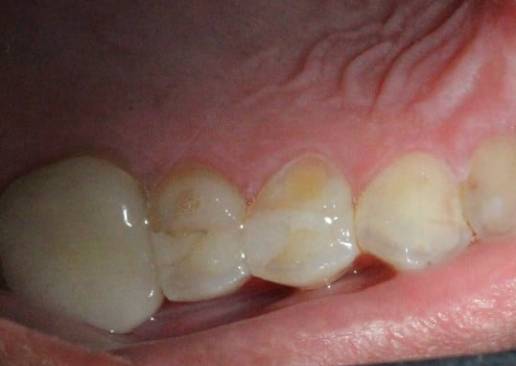 Fractured Tooth before treatment Fractured Tooth before treatment