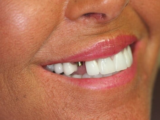 Chipped front tooth before treatment Chipped front tooth before treatment