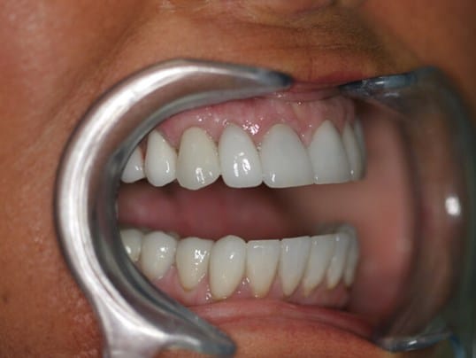 Chipped front tooth before treatment Chipped front tooth before treatment