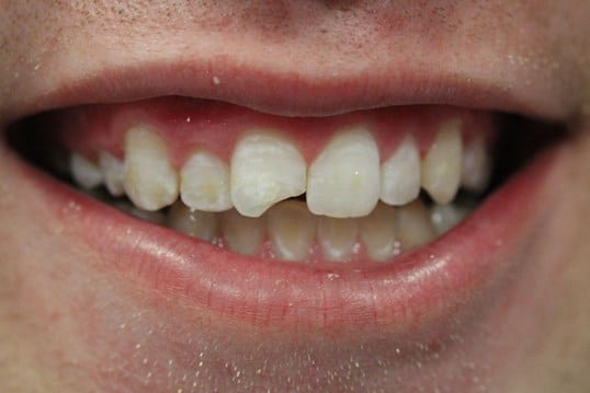 Chipped front tooth before treatment Chipped front tooth before treatment