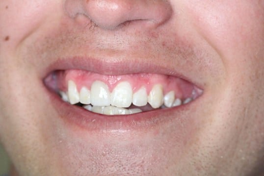Chipped front tooth before treatment Chipped front tooth before treatment