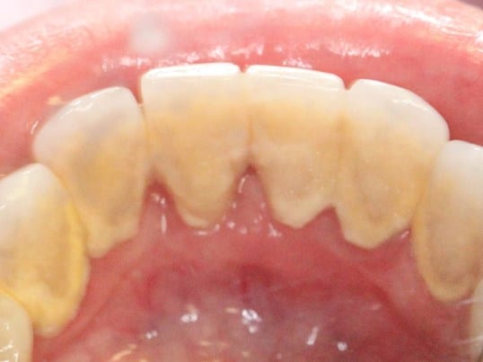 In Needs of A Cleaning before treatment In Needs of A Cleaning before treatment