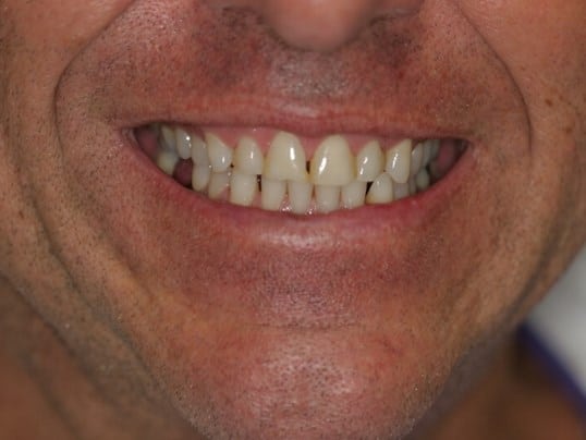 Smile Improvement before treatment Smile Improvement before treatment