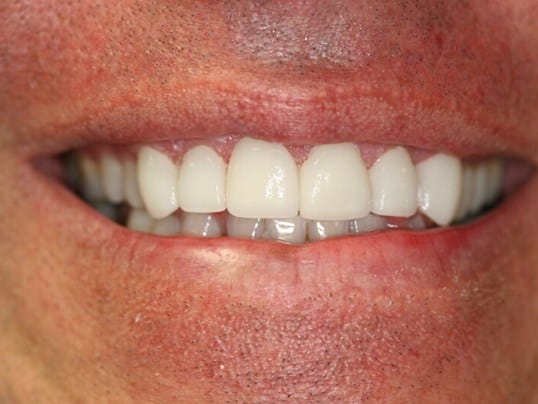 Smile Improvement before treatment Smile Improvement before treatment