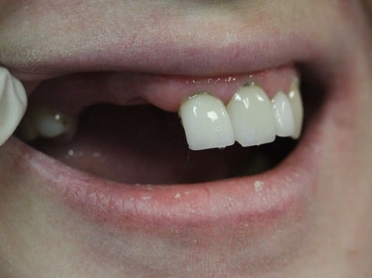 Replace Missing Teeth before treatment Replace Missing Teeth before treatment